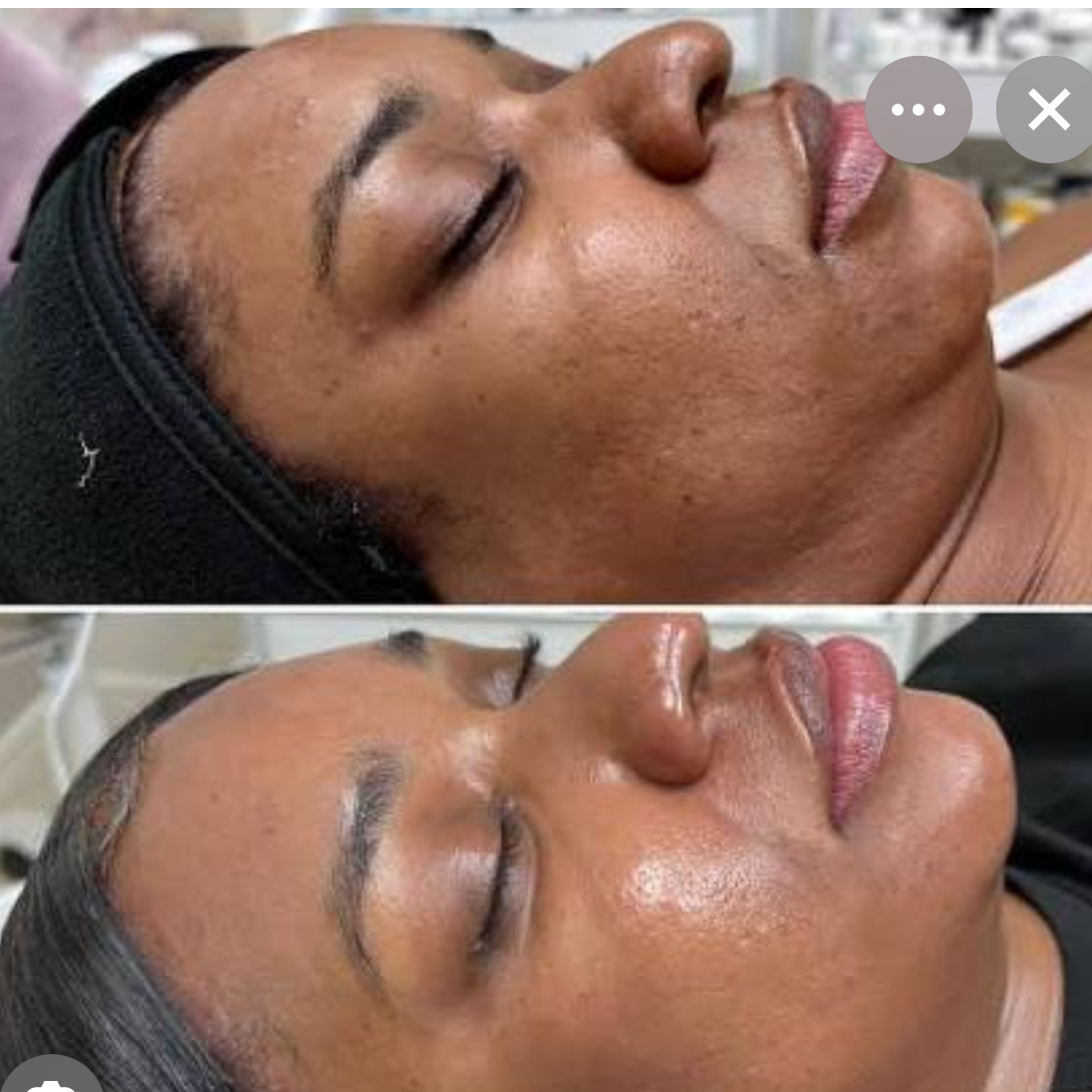 Enzyme Peel Facial at Esthetics With Michaela in Vidalia, LA