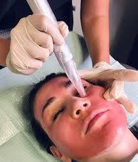 Microneedling