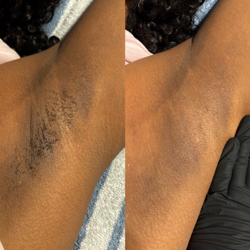 Underarm Wax at LoveThyself Aesthetic in Oklahoma City, OK