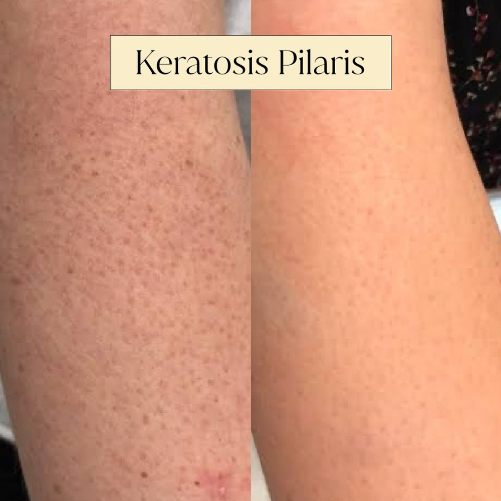 Arm Renewal for KP or Discoloration