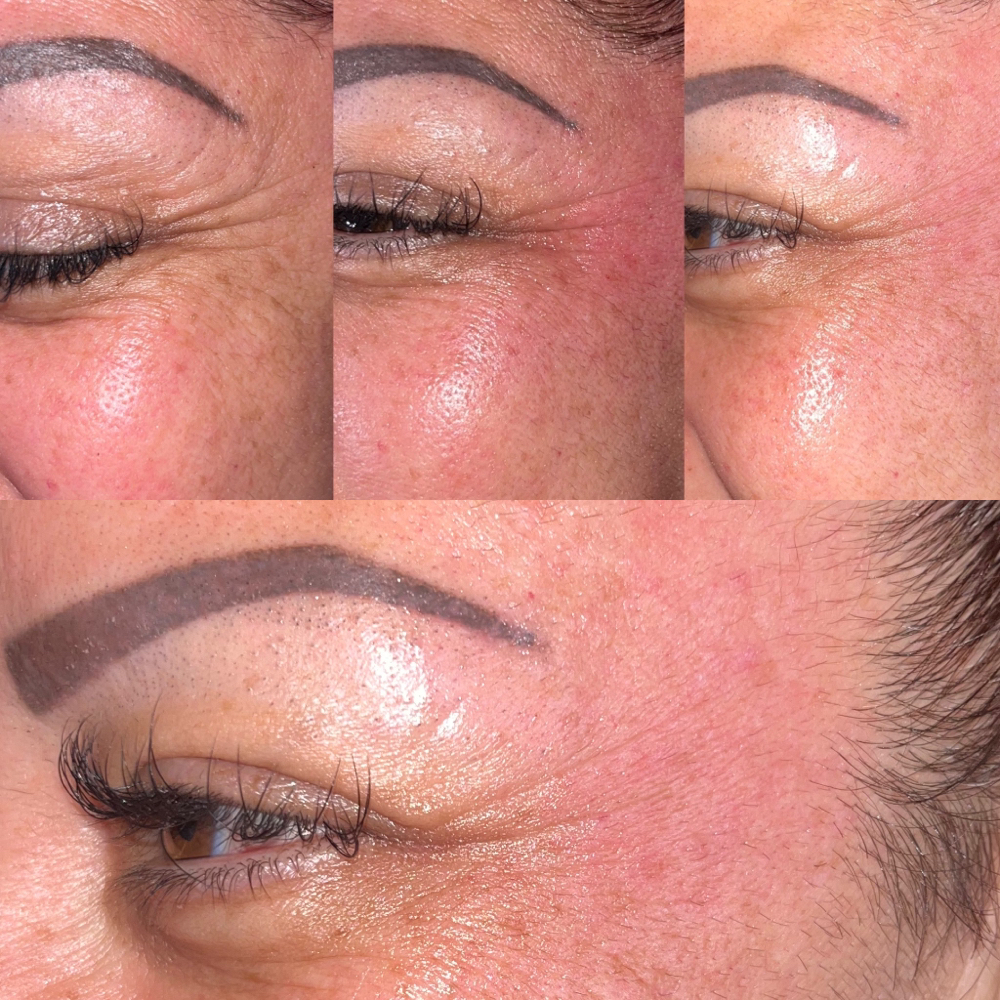 3 Sessions RadioFrequency Face Lift