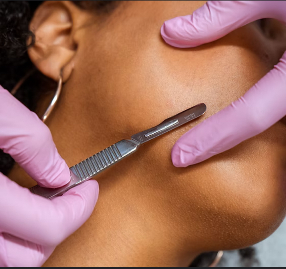 Dermaplane Facial