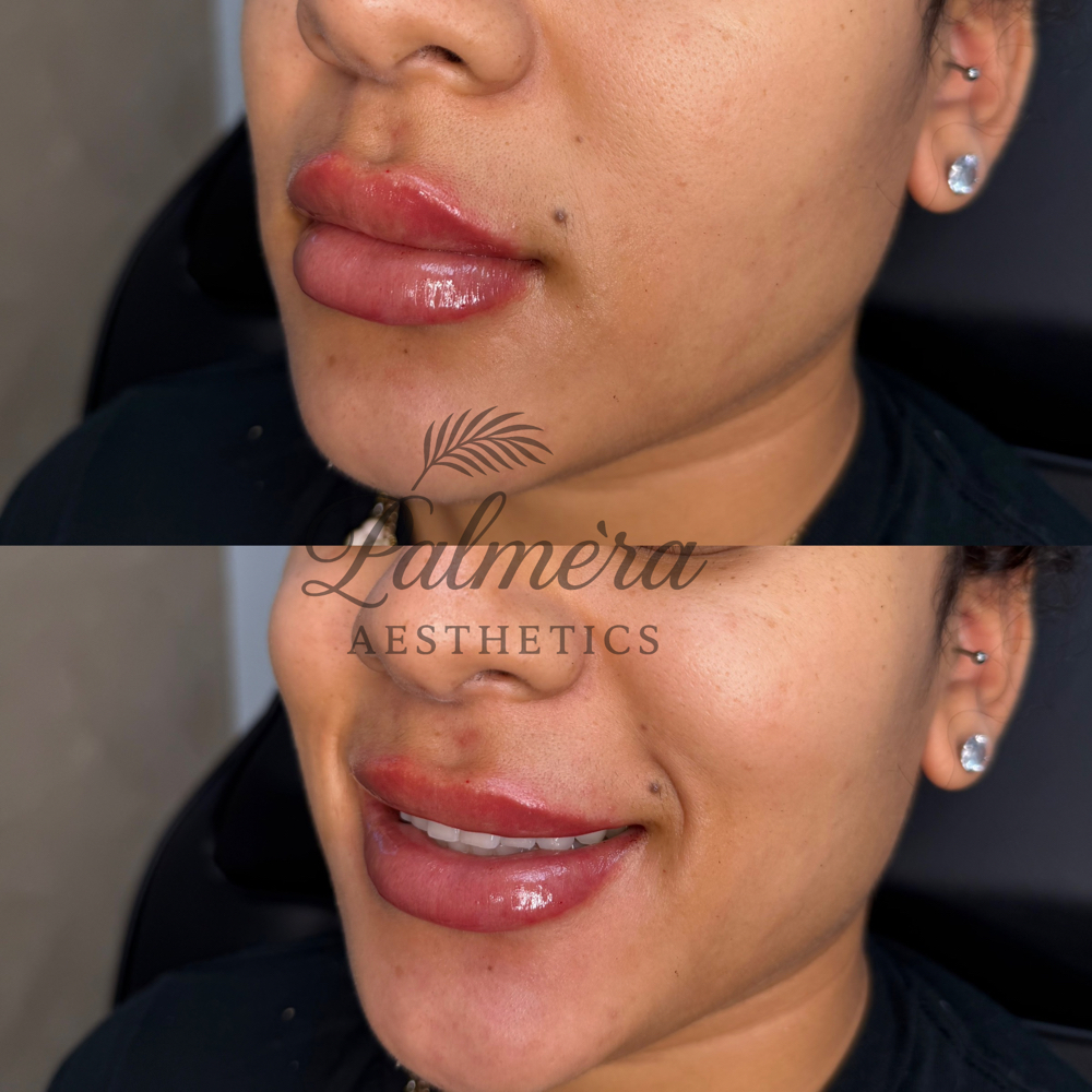 Lip Revival 1.2ML at Palméra Aesthetics in Killeen, TX