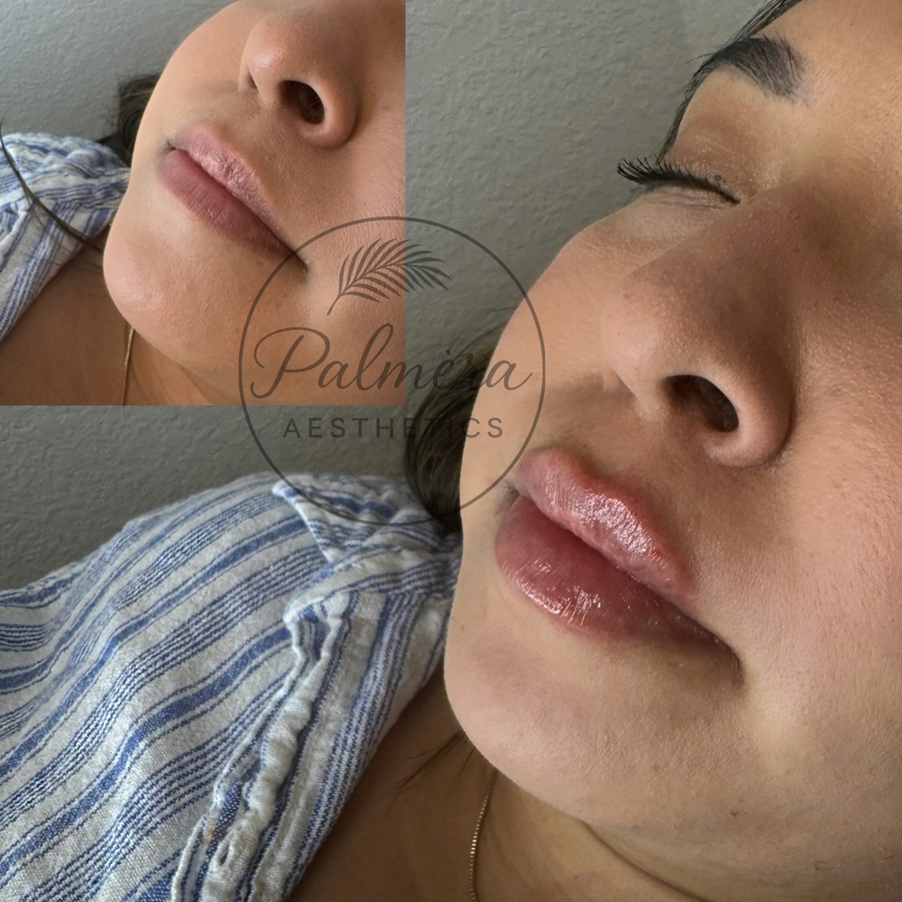 Lip Revival 1.0ML at Palméra Aesthetics in Killeen, TX