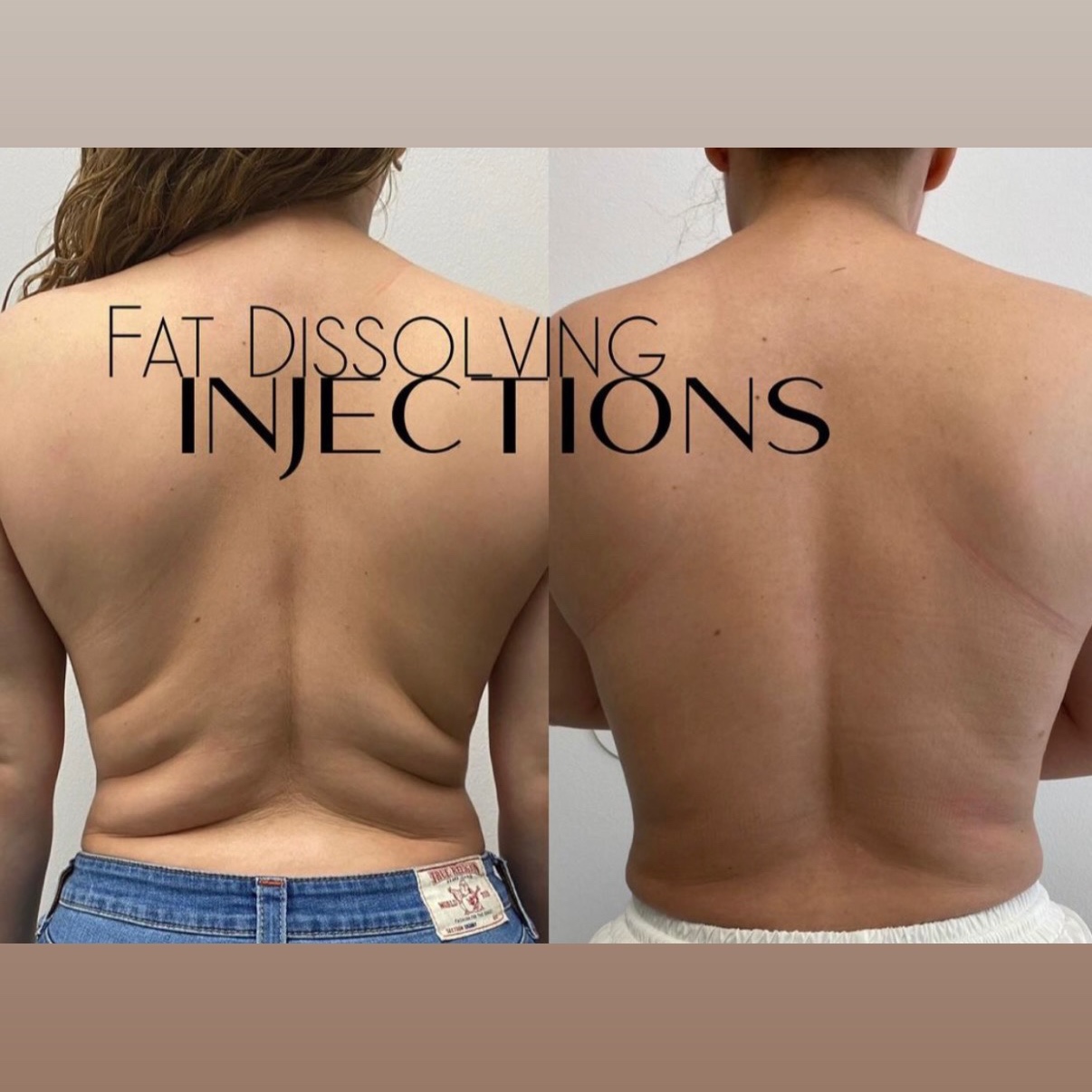 Lipo 360 Back Fat at Gold Stone Beauty in mcallen, TX