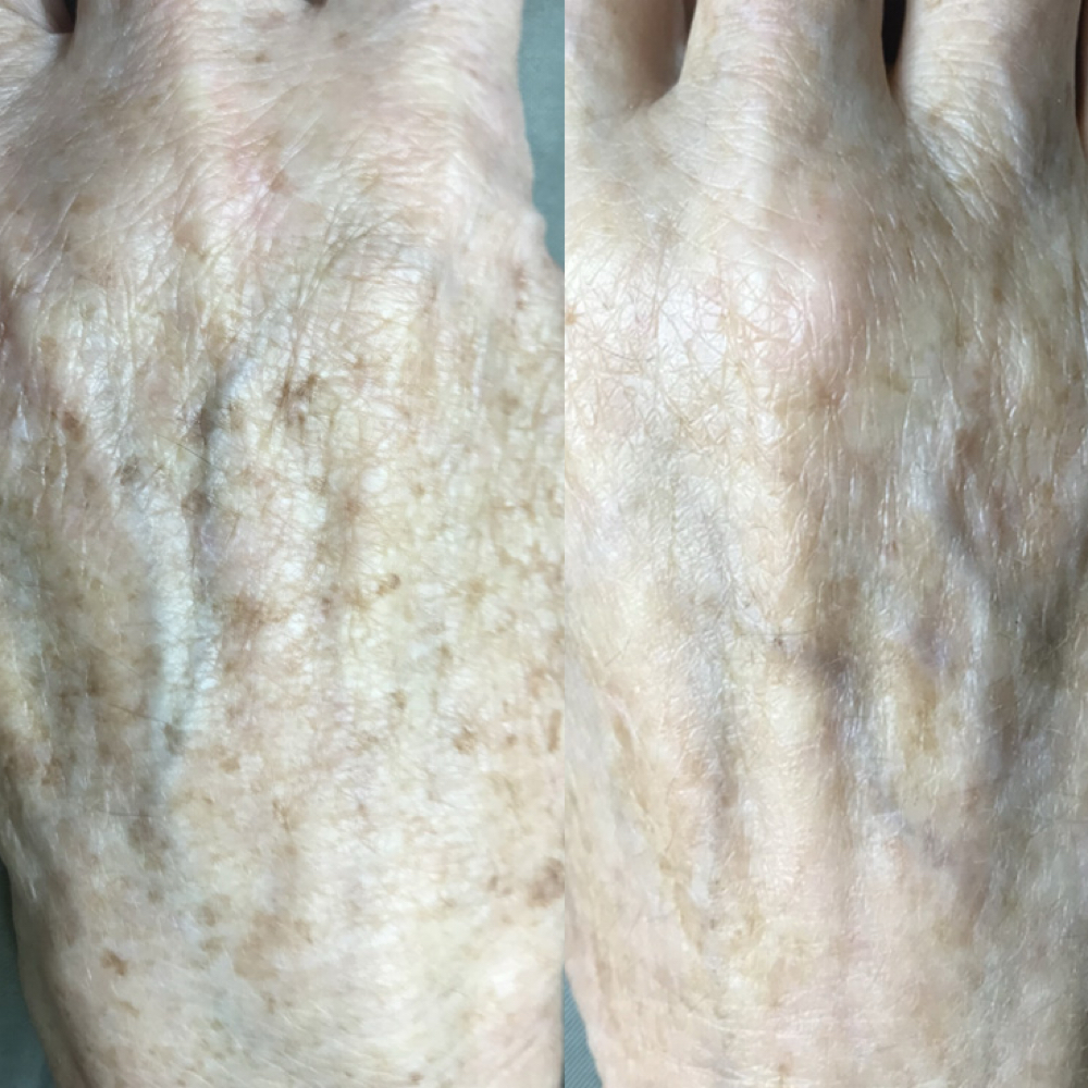 Brightining Hand Treatment Add On at Yadis Nails & Spa Laser in Austin, TX