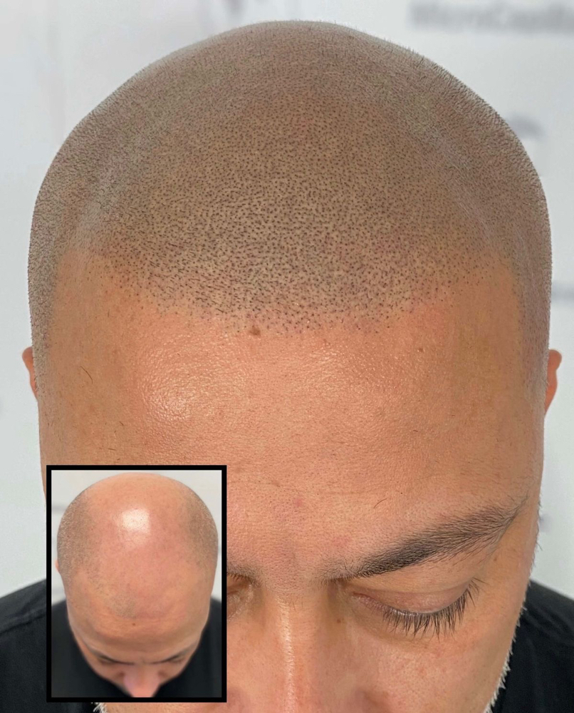 Scalp Micropigmentation