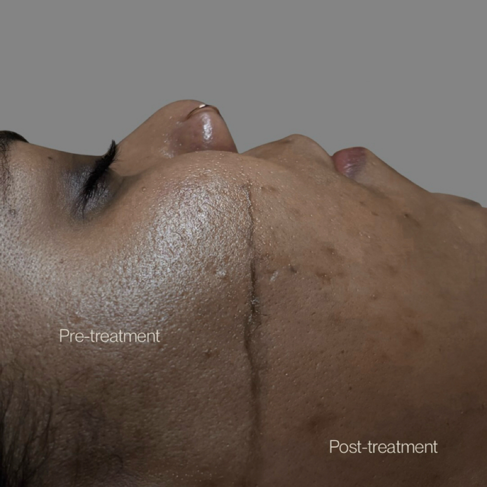 Dermaplane at Windhorse Esthetics in Loveland, CO