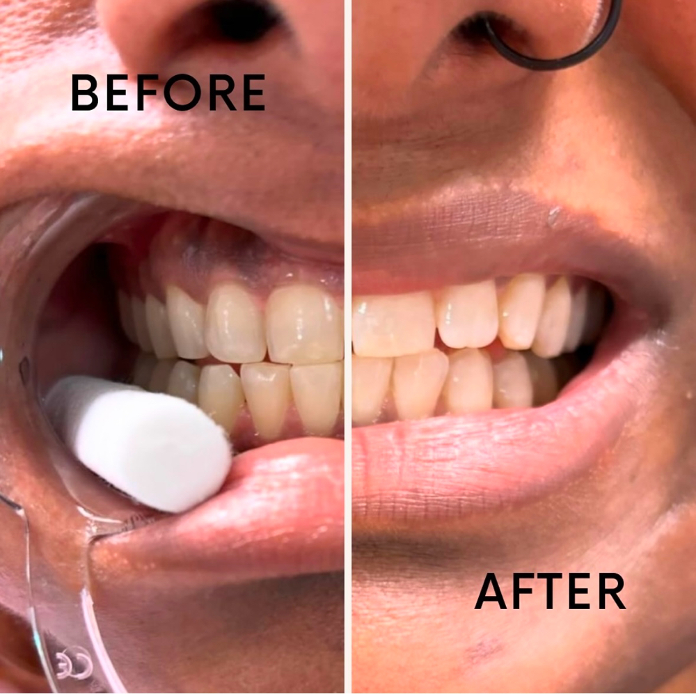 40 Minute Teeth Whitening
