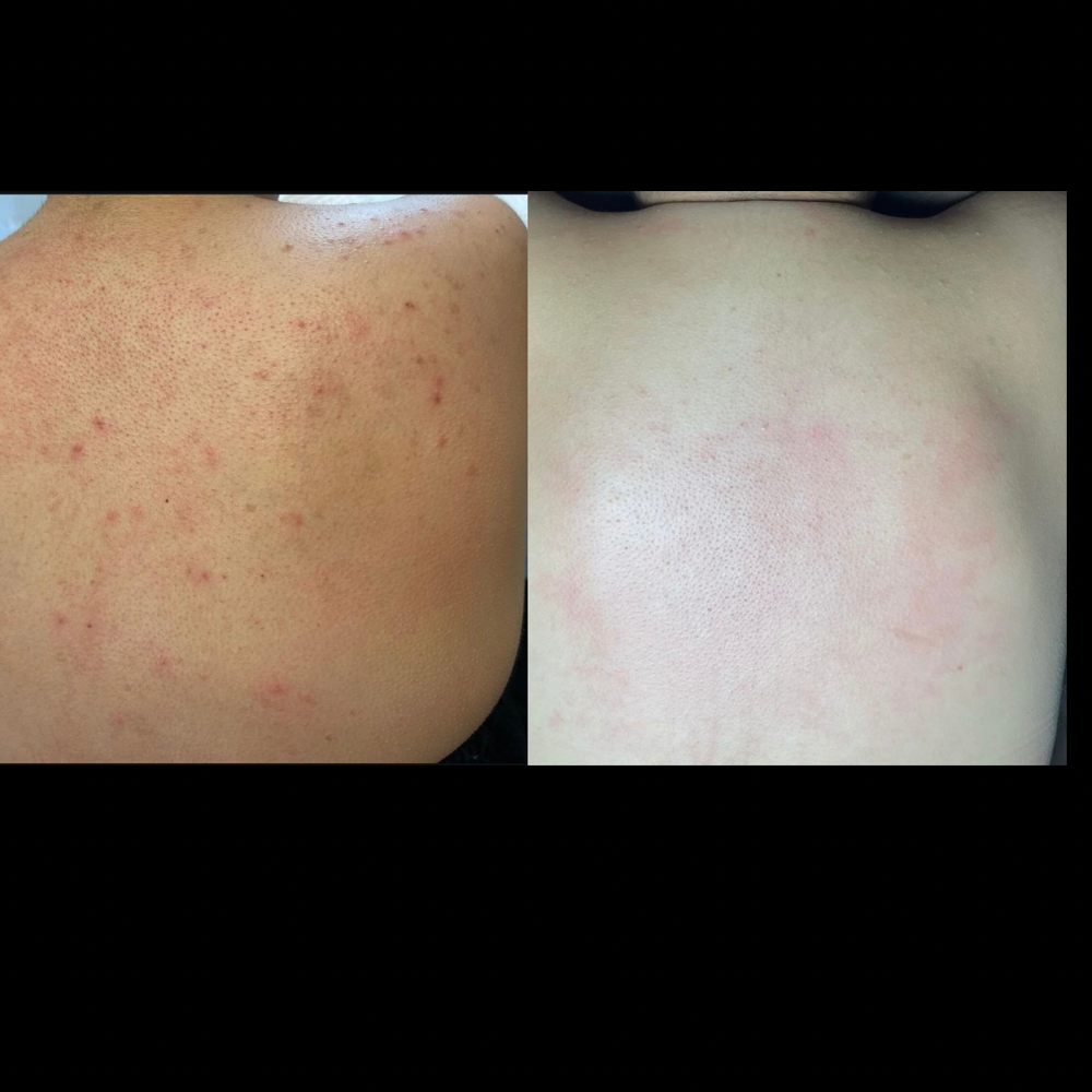 Back Chemical Peel