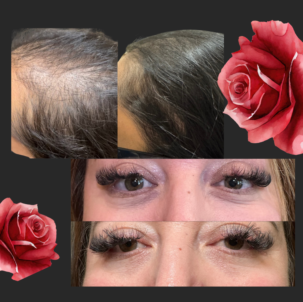 PRP/ PRF Injections at Forever Young Beauty RN in Rowlett, TX