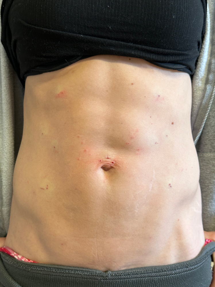 Nonsurgical Tummy Tuck at Aesthetic NP Marie in Portland, OR