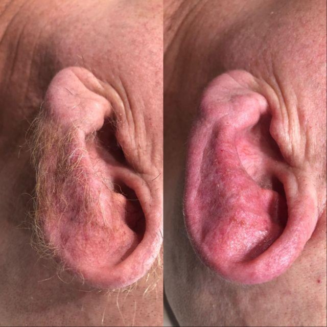 Ear Wax at Irines Spa in Roanoke, VA