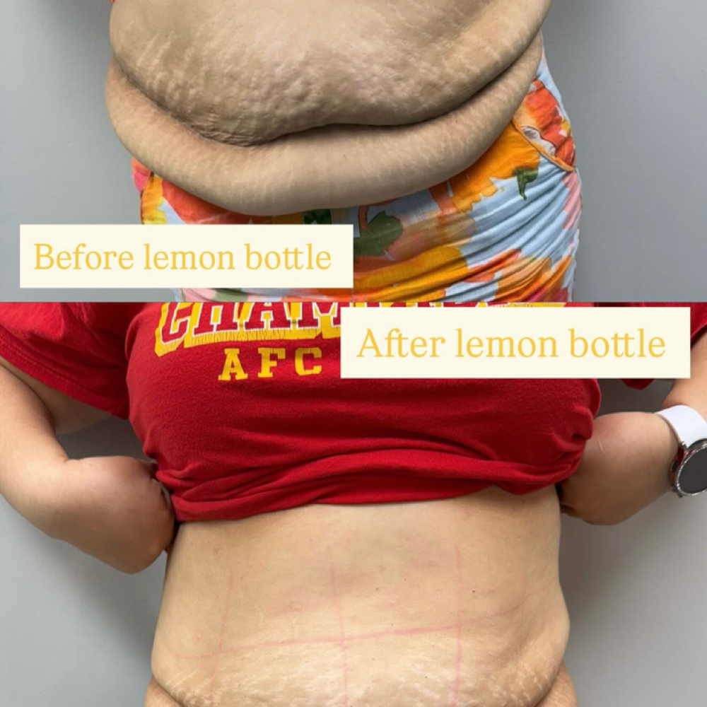 Session 3 Fat Dissolve