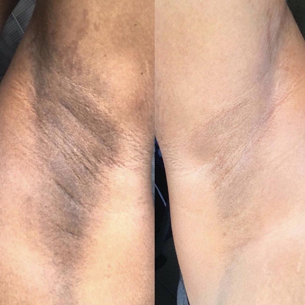 BALNQUEAMIENTO INTIMO - 6 SESIONES at ROSTRO PERFECTO in Hialeah, FL