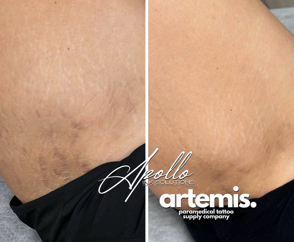 Stretch Mark + Scar Rejuvenation