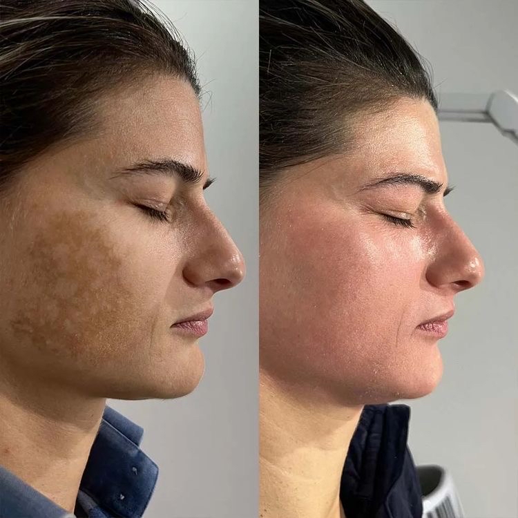 Chemical Peel Level 1