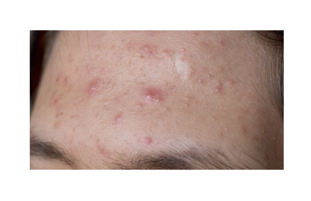 ACNE BE GONE