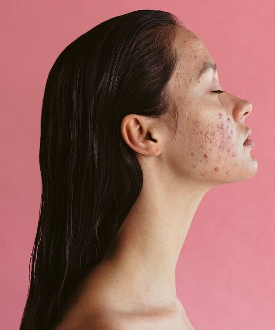 Acne Peel