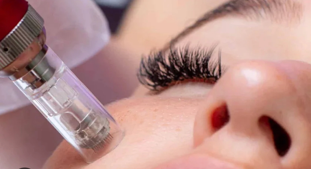 Microneedling ( Micro-channeling )