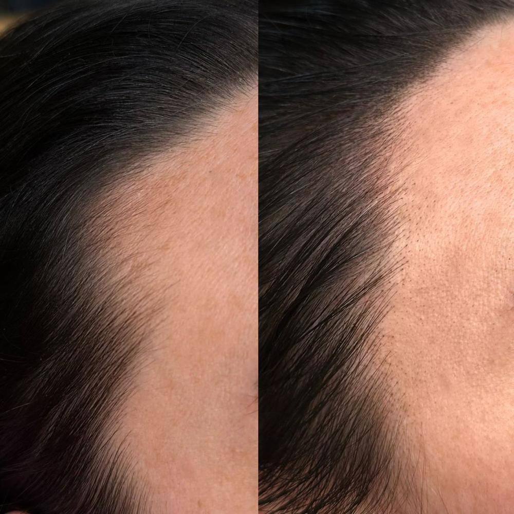 Microblading: Hairline Enhancement