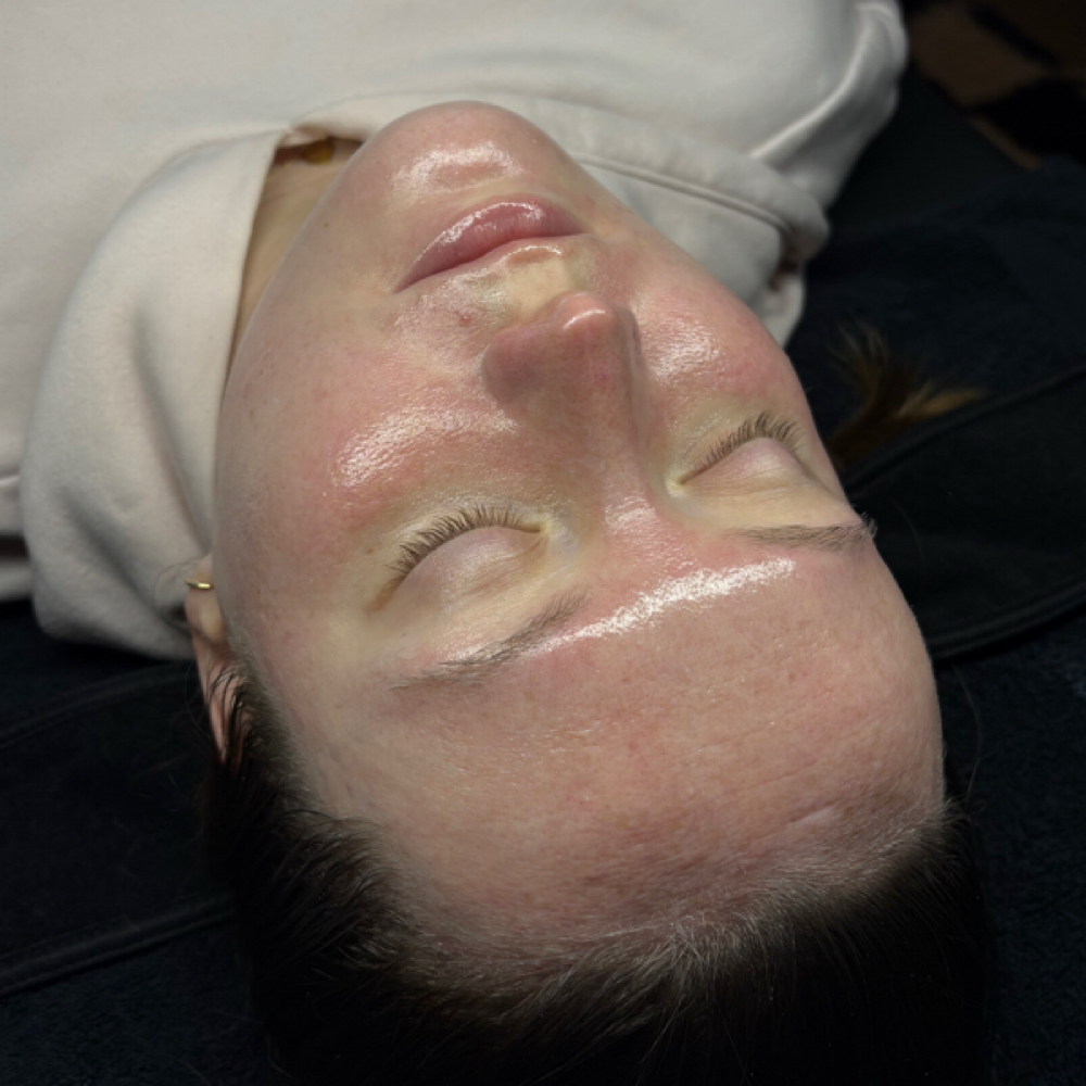 Custom Chemical Peel at Esthetics By Emmy K in Greenwood, IN