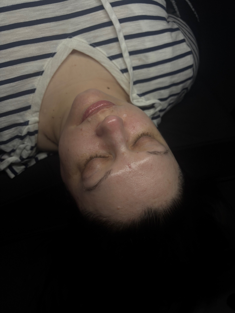 Oxygen Chemical Peel