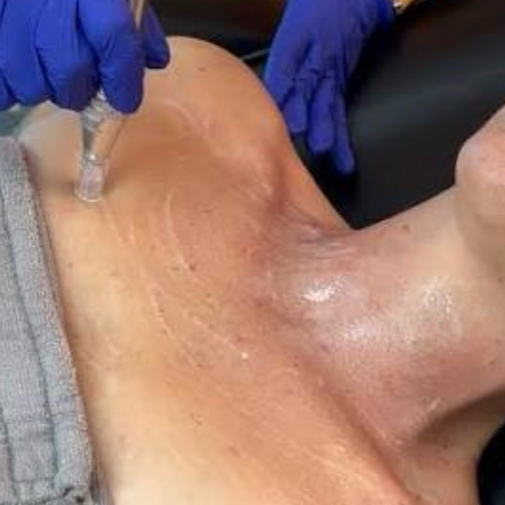 Collagen Induction For Neck And Dec