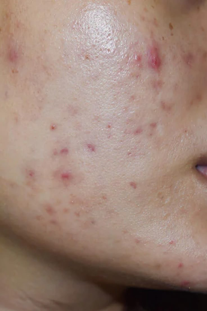 Face Reality Acne Facial