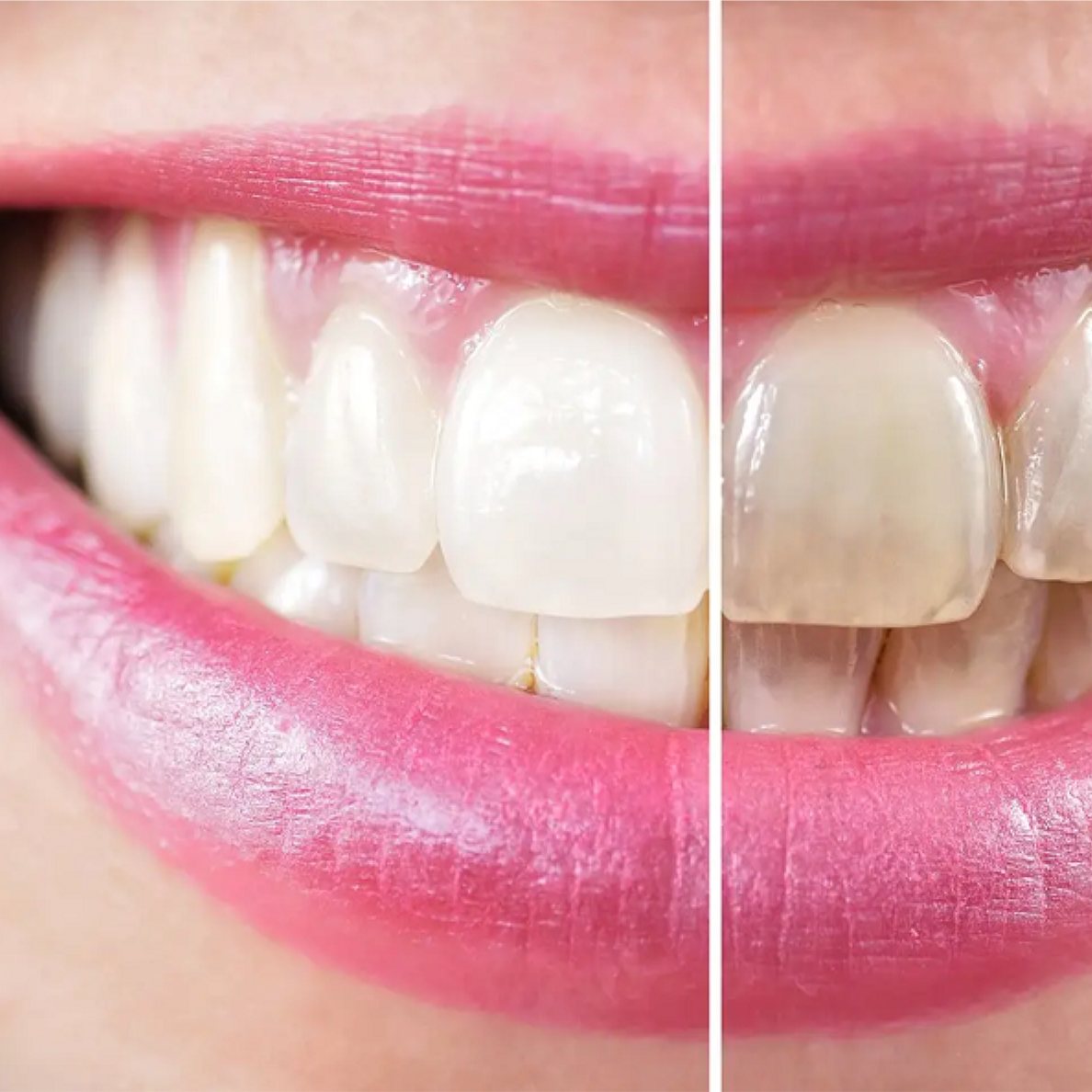 Cosmetic Teeth Whitening 3 Sessions at Beauty By Angel in Lebanon, KY