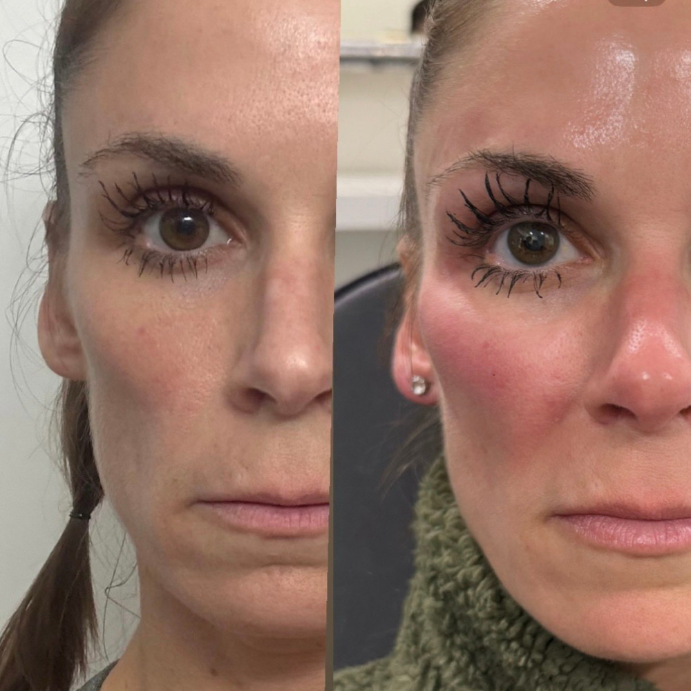 Filler: Cheek/Chin/temple/jaw