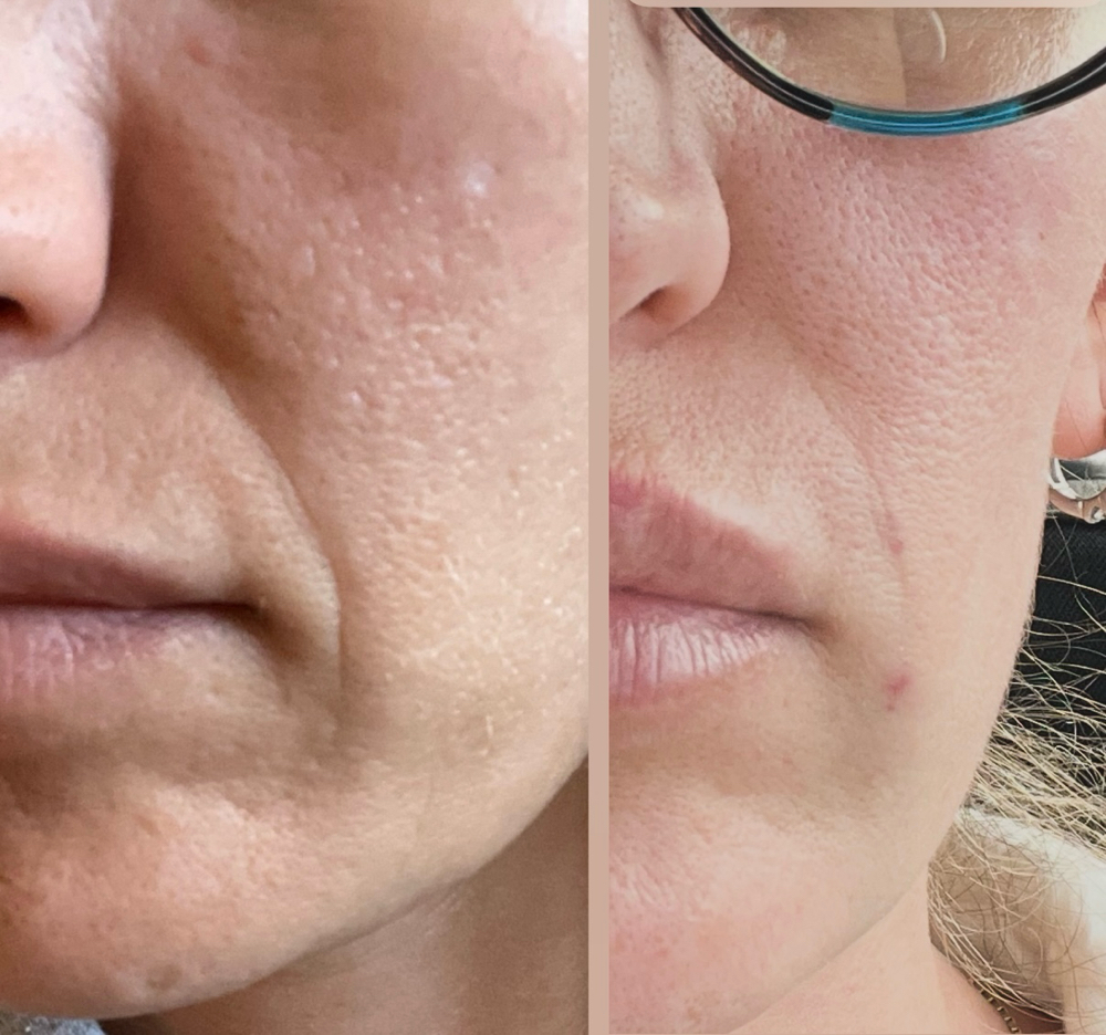 Cheek/Chin Filler Consult