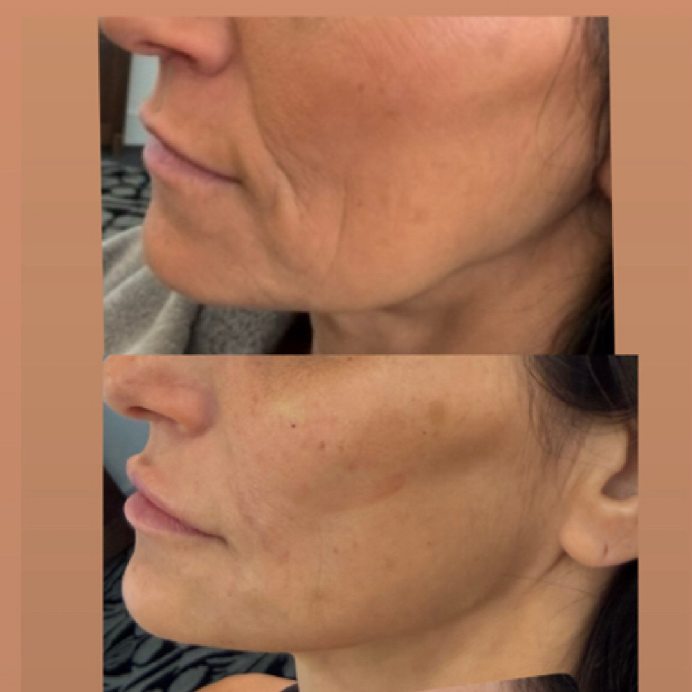 Filler 💉 at Nueva Vida Medspa in Audubon, NJ