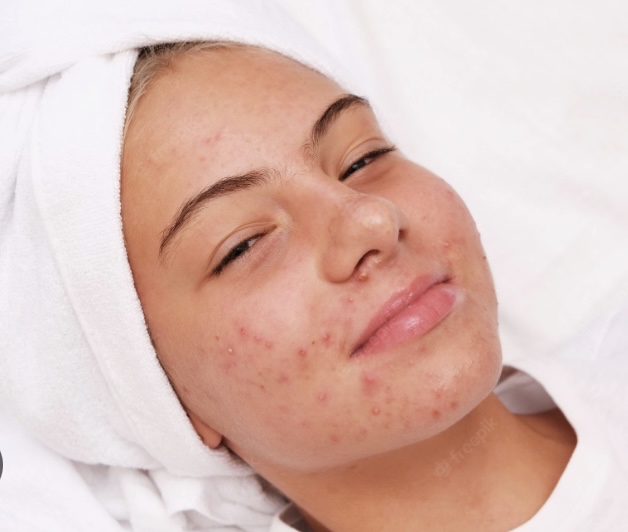 Teenage Acne Facial