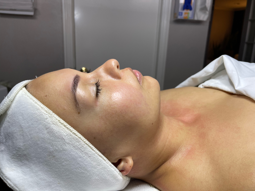 Microneedling + Stem Cells