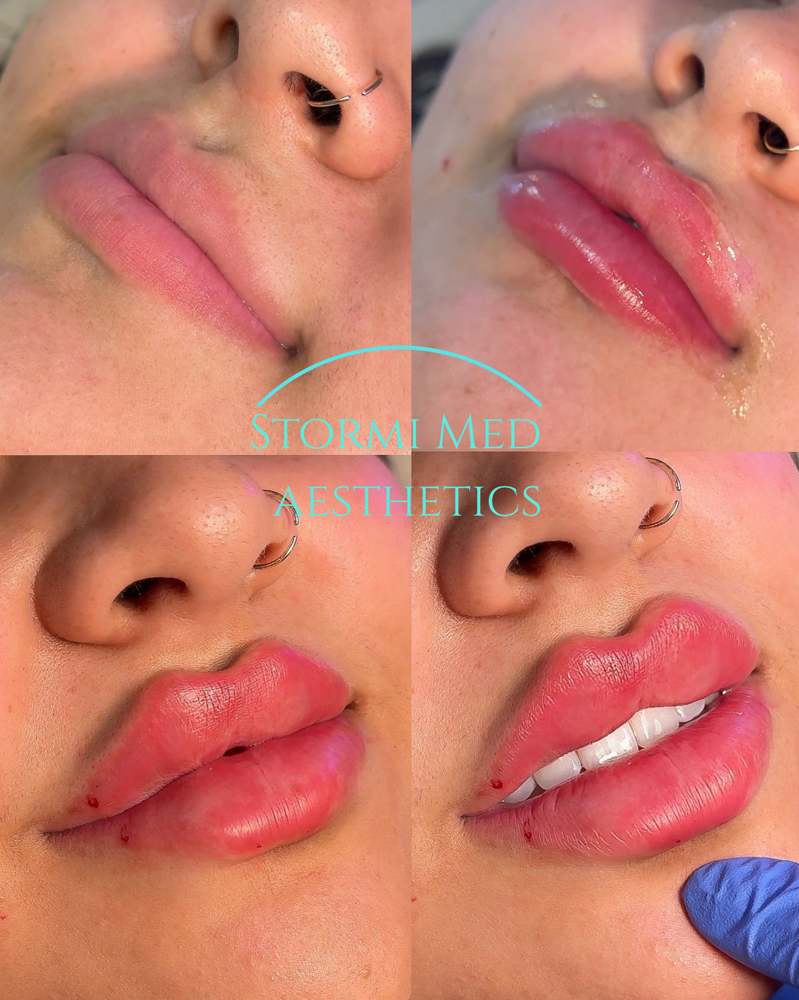 Full Syringe Russian