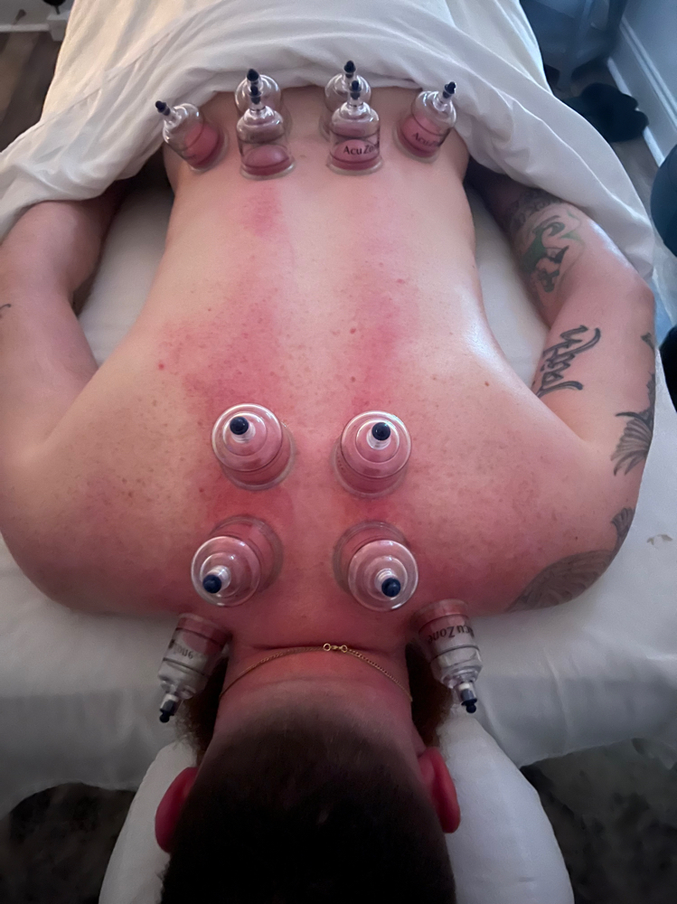 Serene Cupping Therapy