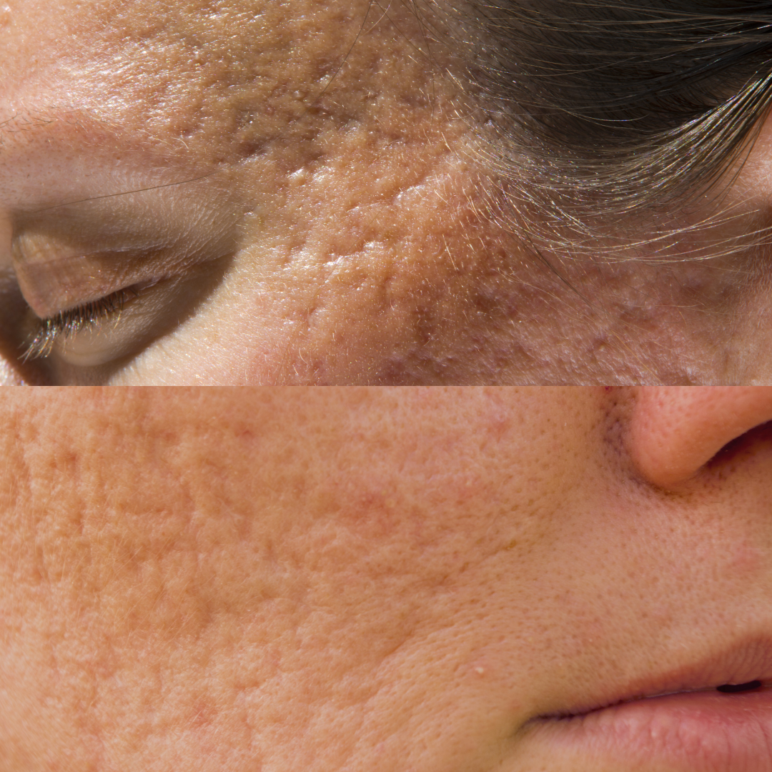 Acne Glow Up Package