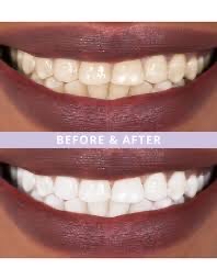 45 MIN SUPER SMILE