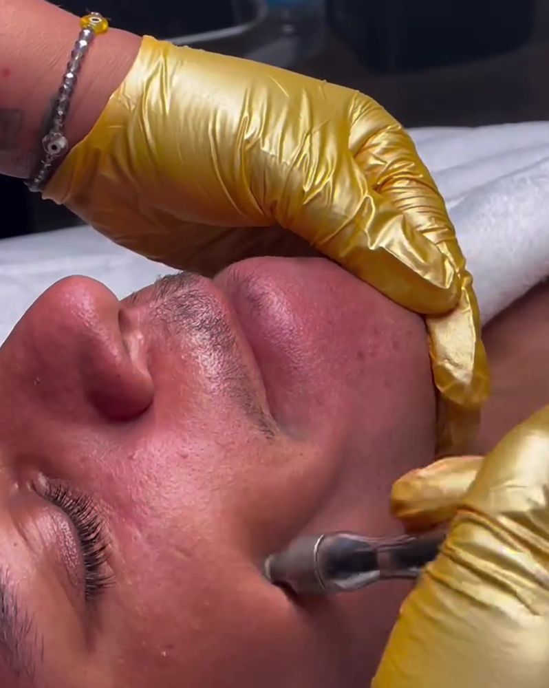 Microderm Treatment (8 Weeks)