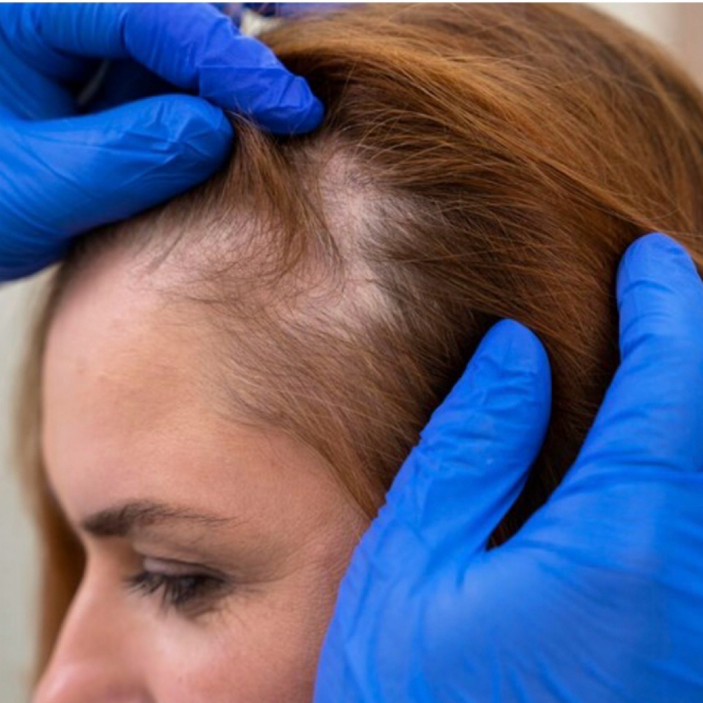 Scalp Consultation (no BCA) at Hair Saviours in Stafford, VA