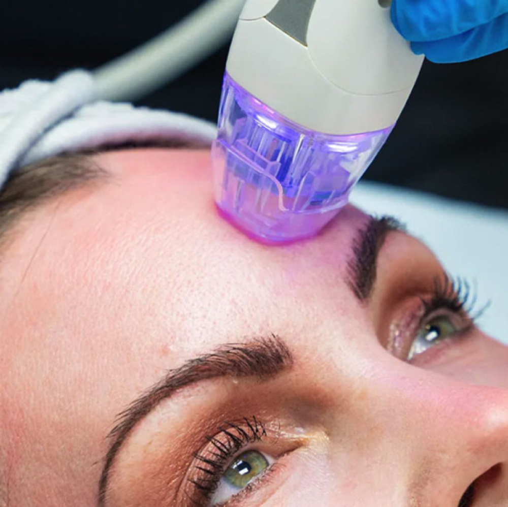Microneedling at Lilies Boutique Day Spa in Lanesboro, MN
