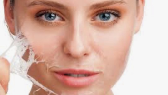 Chemical Peel