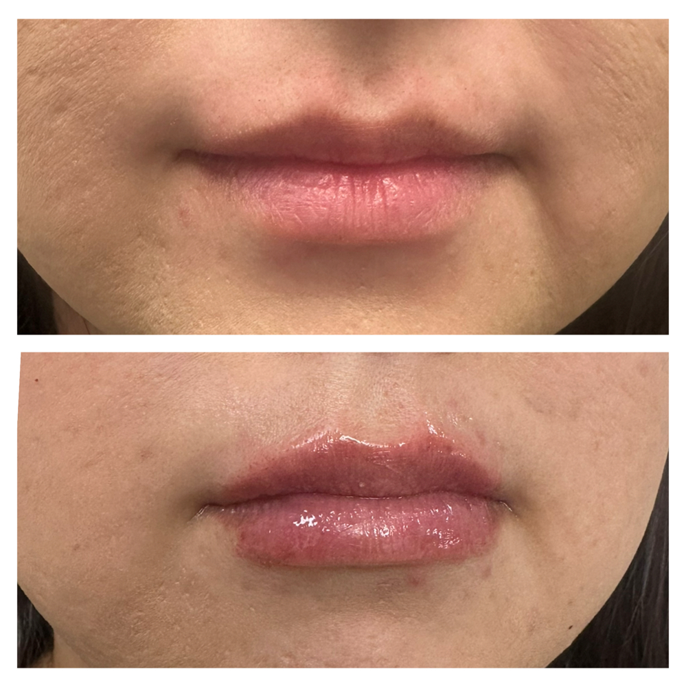 Lip Filler 1/2 0.5ml