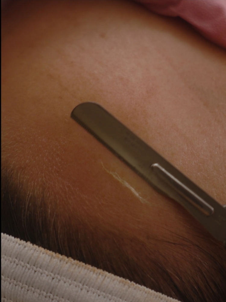 Just Peach Fuzz Removal