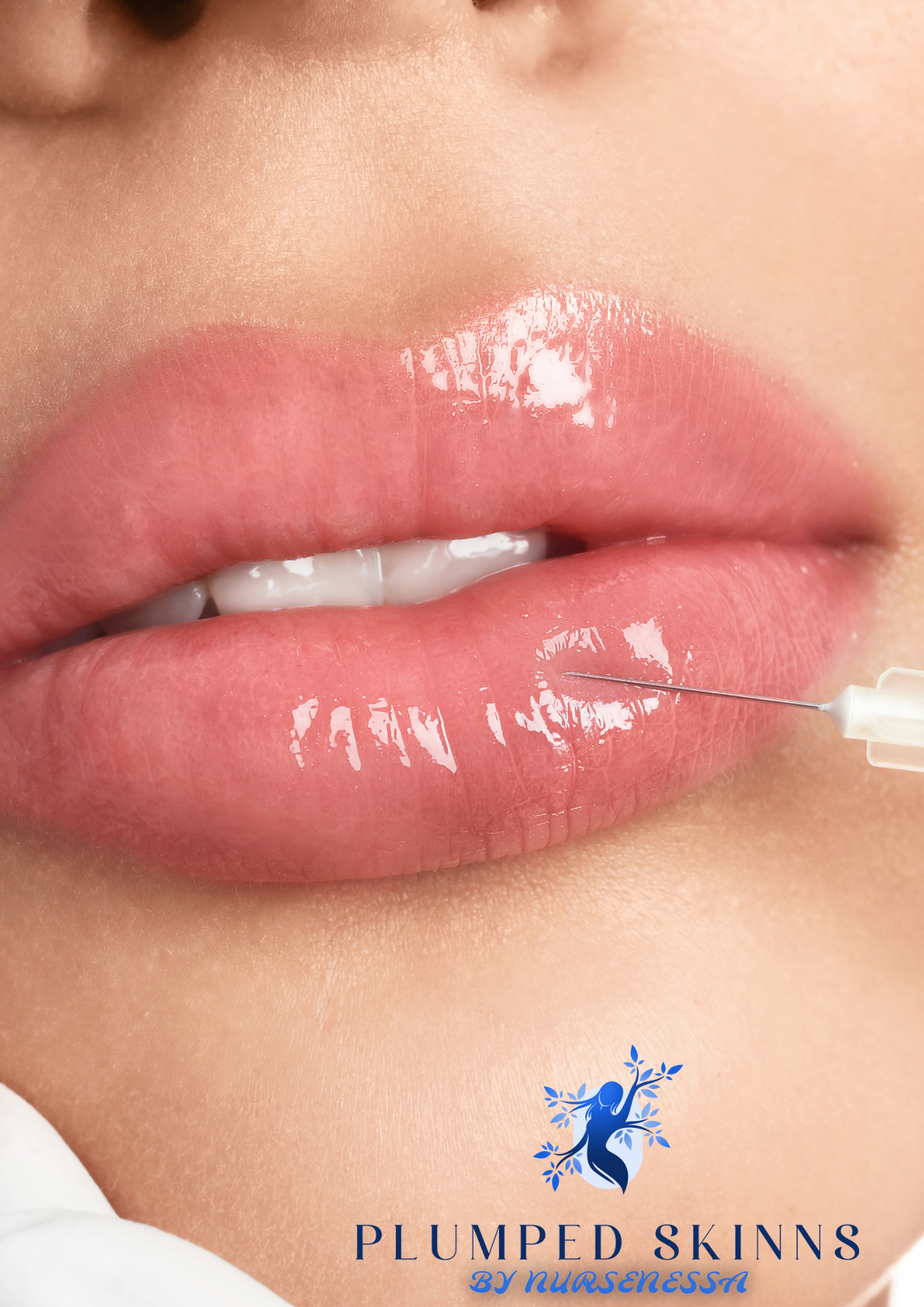 Lip Filler