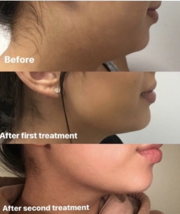 Face Slimming