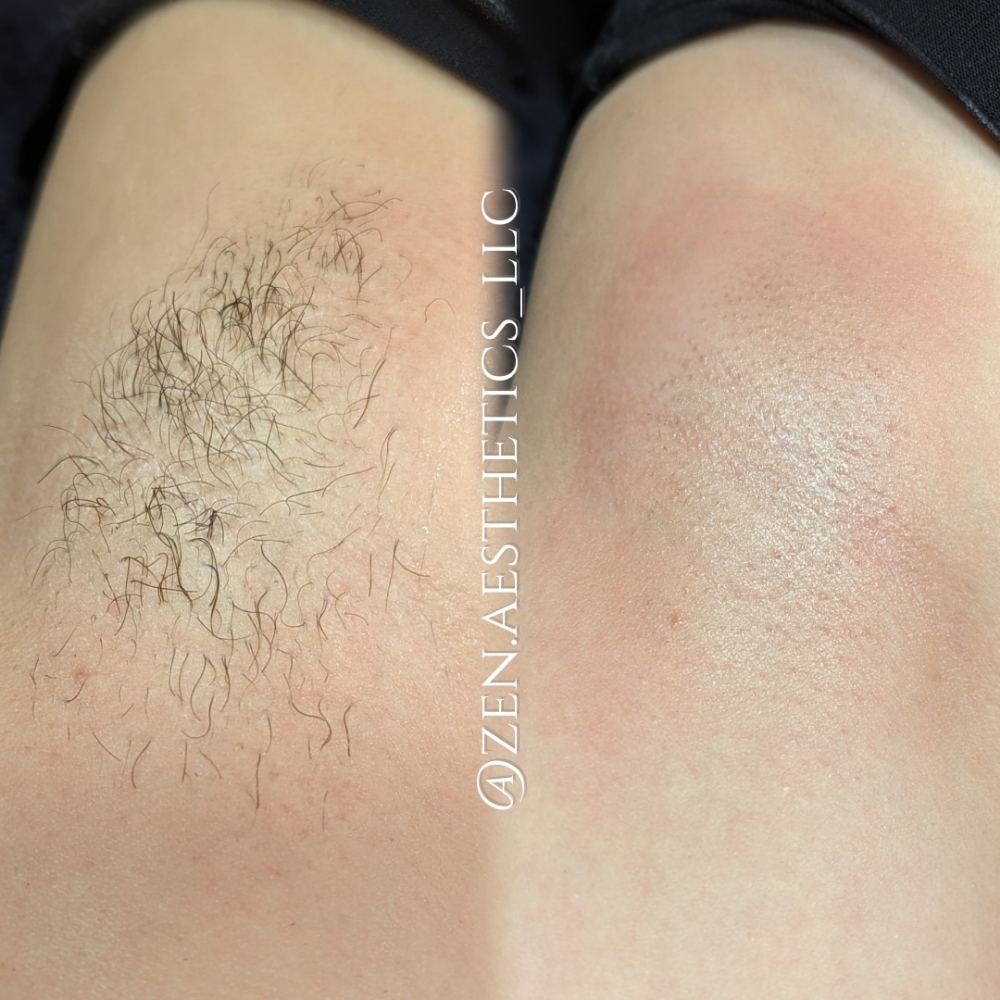 Hair Removal (Waxing)