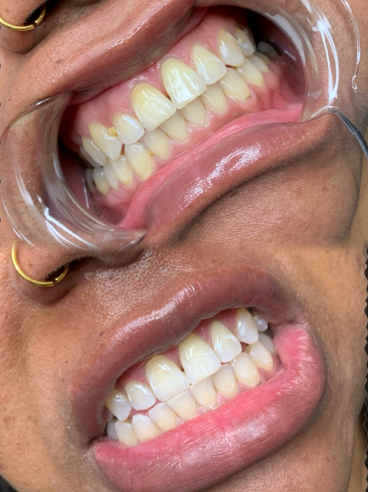 30min Follow-Up Teeth Whitening