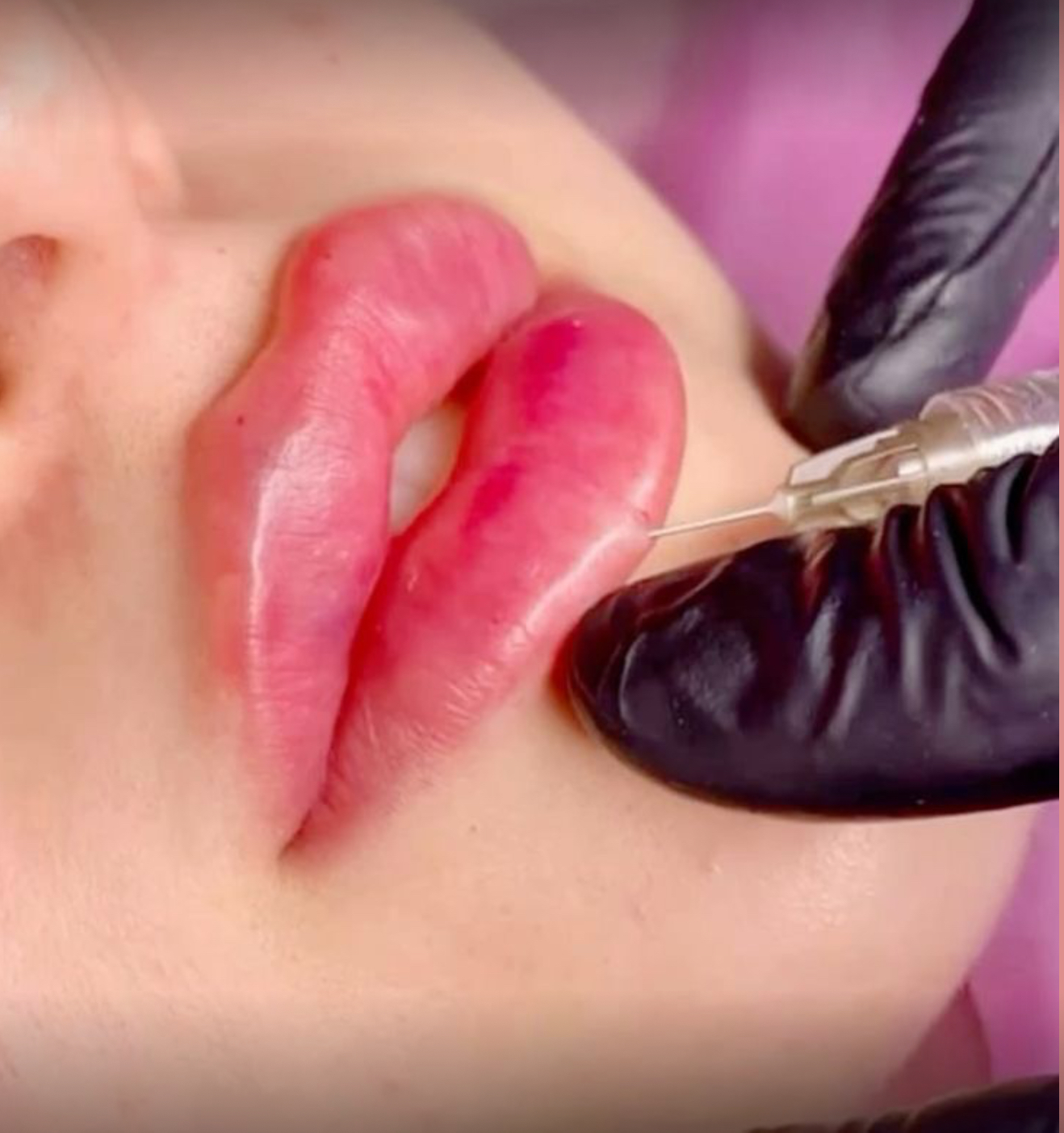 Lip Filler